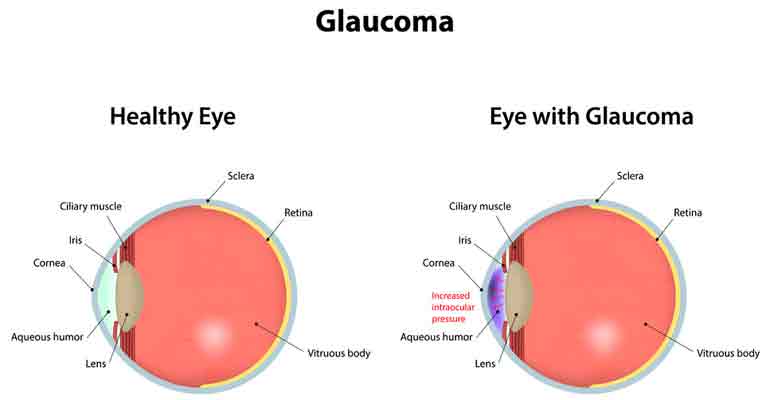 Glaucoma