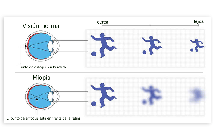 Miopía, hipermetropía y astigmatismo