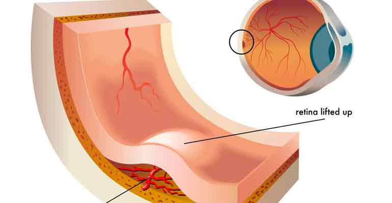 Desprendimiento de retina